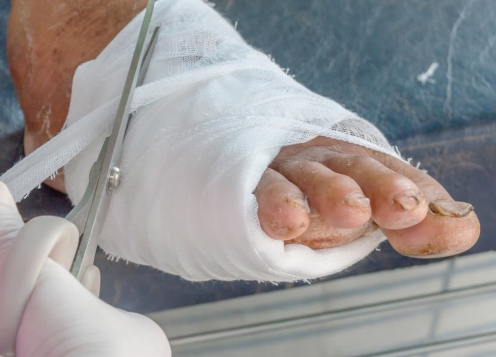 Diyabetik Ayak Bakımı